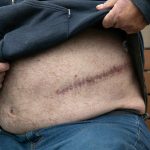 George Beard lifts his shirt to show a massive scar from an abdominal surgery he had a few years ago on May 23 while sitting outside the Stanwood Library. Between the abdominal surgery and a leg surgery around the same time, Beards health and medical bills have left him living out of his car, unable to work. (Ryan Berry / The Herald)